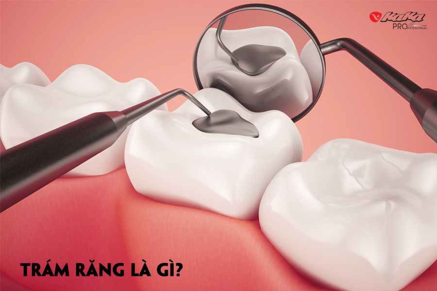Trám răng là gì?