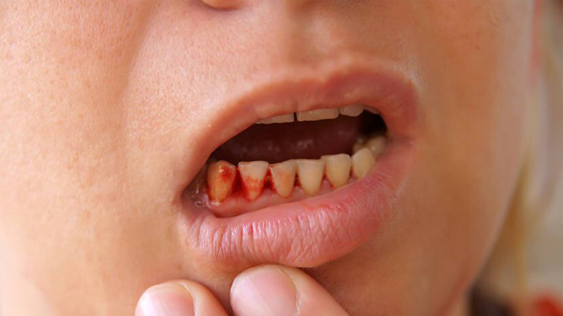 Vệ sinh bàn chải sai cách gây ra các vấn đề răng miệng