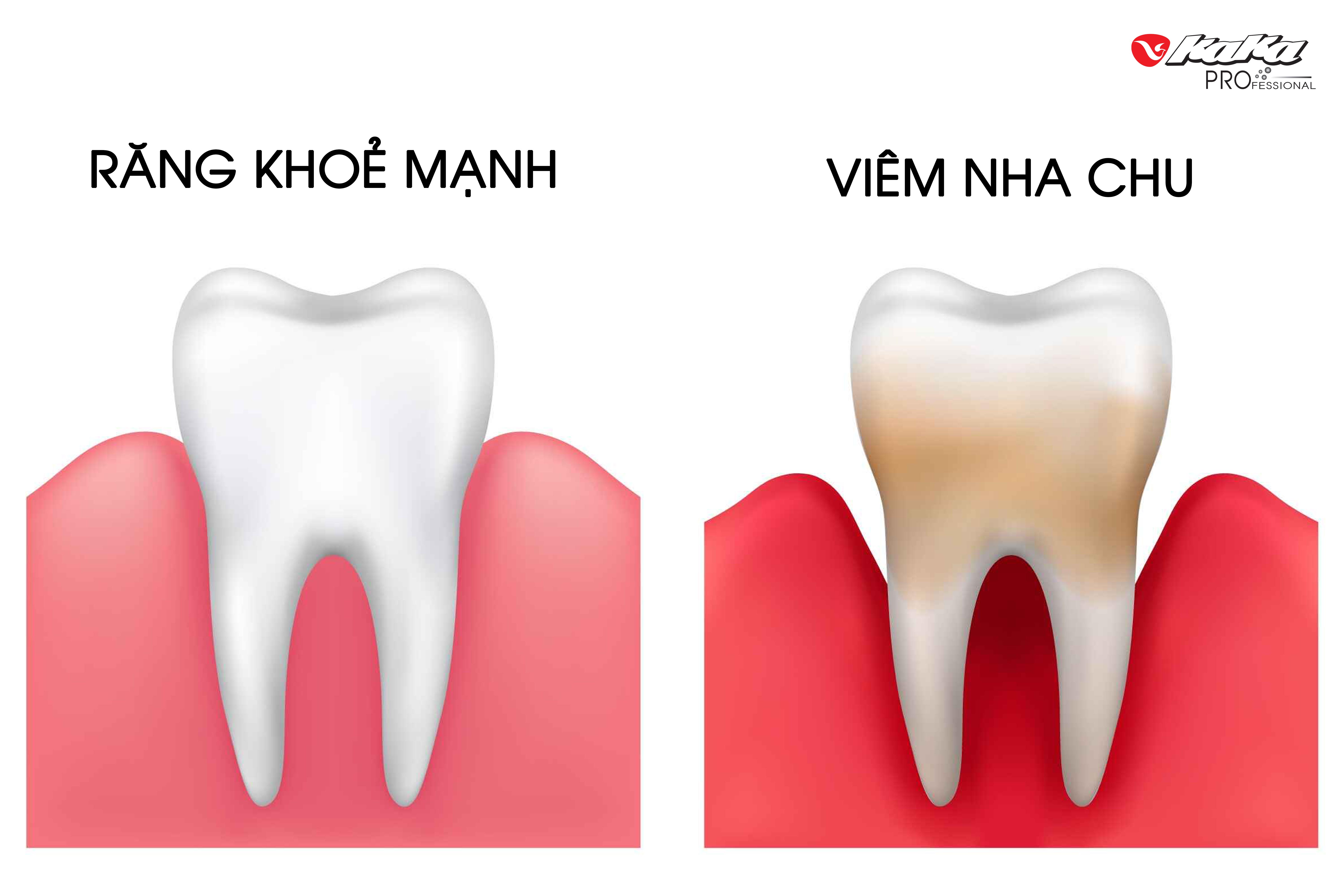 Viêm nha chu là gì?