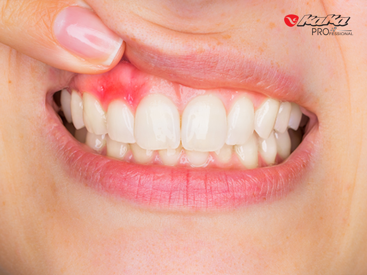 Viêm nha chu liên quan đến các bệnh tim mạch