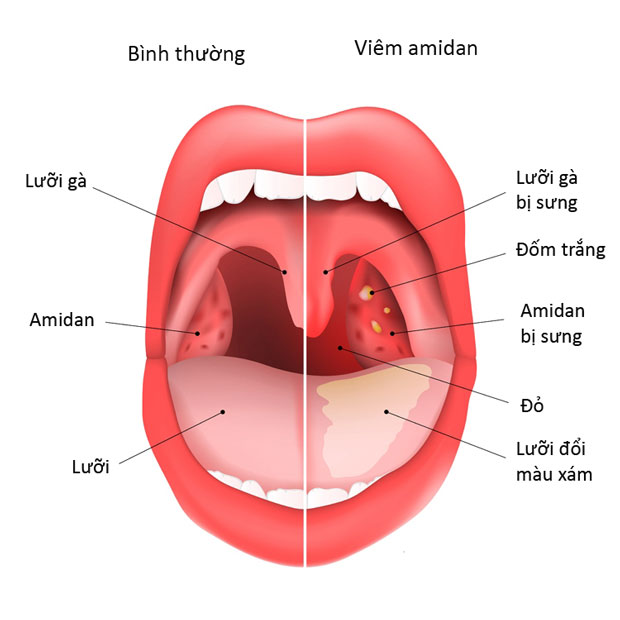 Dấu hiệu viêm VA