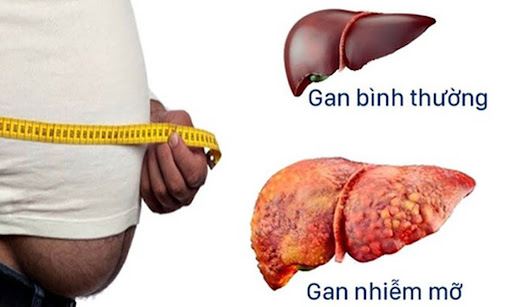 Gan nhiễm mỡ độ 1: Nguyên nhân và các dấu hiệu bệnh