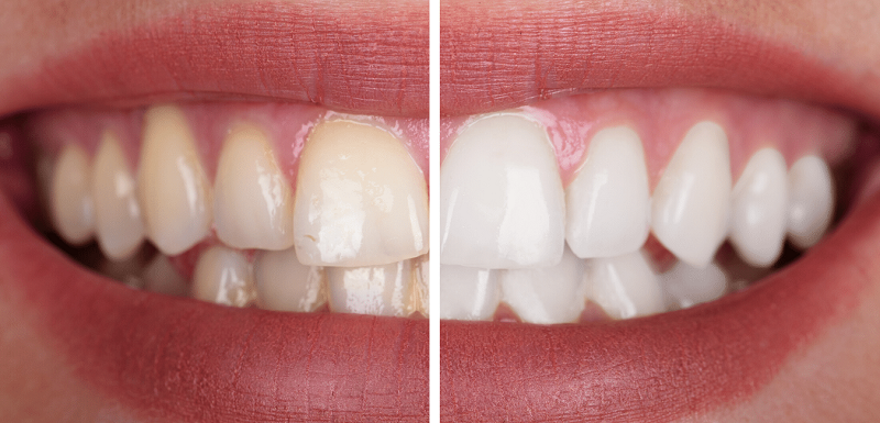 Nên tẩy trắng răng tại nhà hay phòng khám nha khoa?