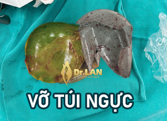 túi ngực rách nhiều mảnh