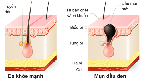 Nguyên nhân hình thành mụn đầu đen