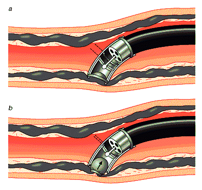 Thắt tĩnh mạch thực quản