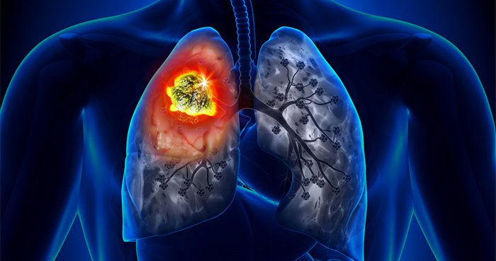 Điều trị ung thư