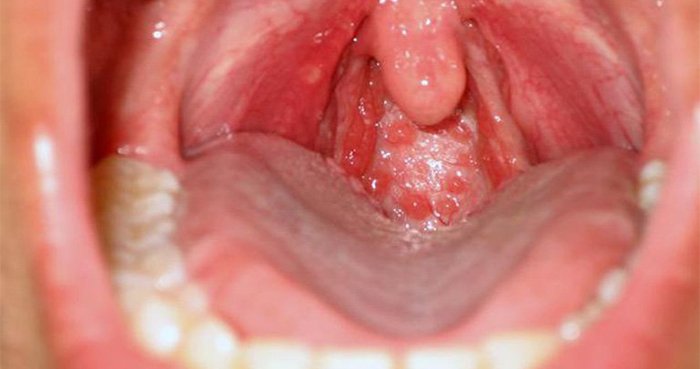 Phòng bệnh viêm họng hạt