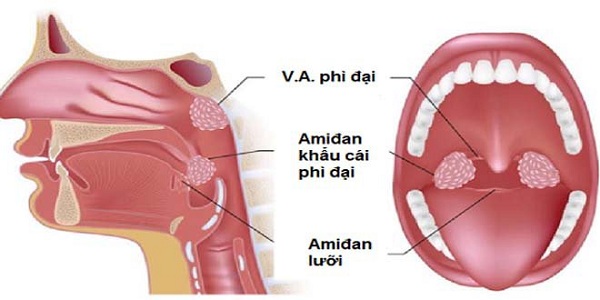 Vi khuẩn xâm nhập quá lâu là nguyên nhân gây ra tình trạng viêm amidan