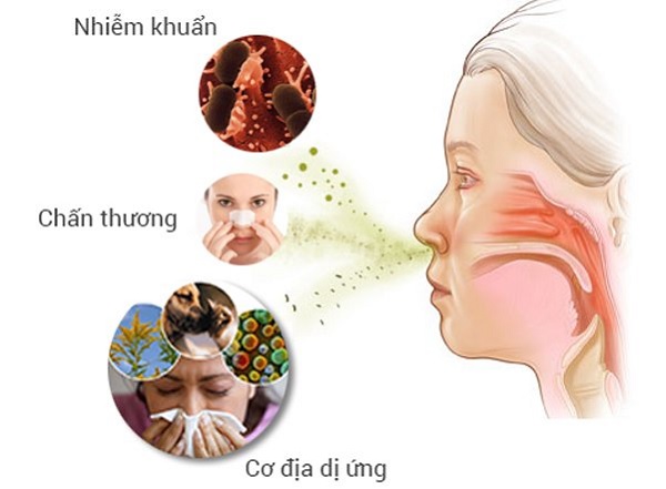 Những nguyên nhân nào dẫn đến mắc bệnh viêm mũi dị ứng?
