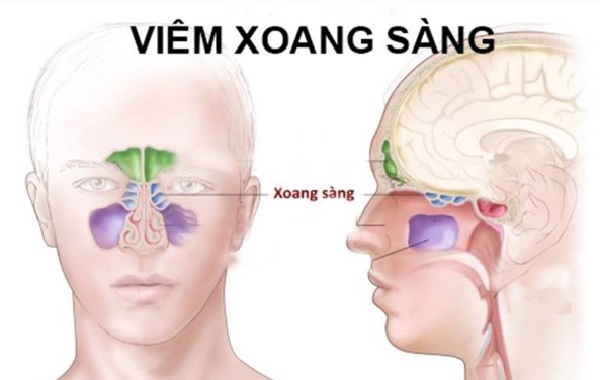 Viêm xoang sàng sau - một bệnh hay bị bỏ qua