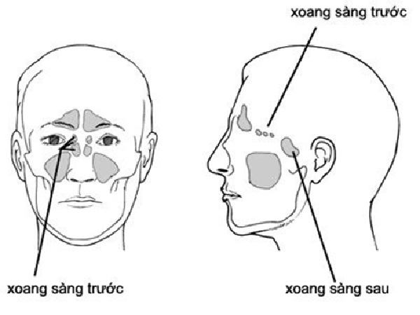 Bệnh viêm xoang sàng sau là gì?