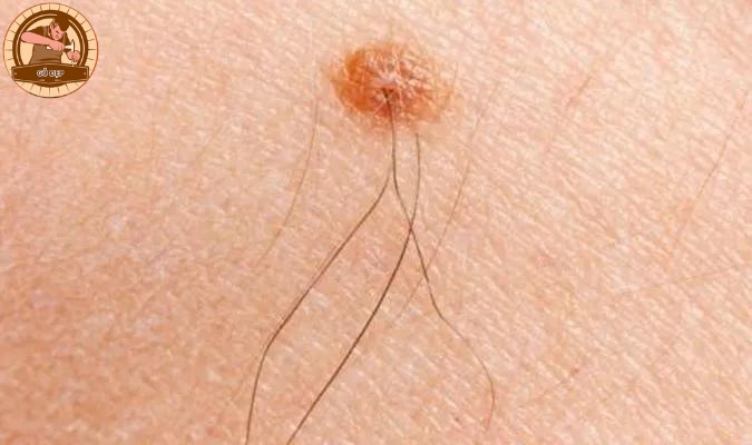 Vì sao nốt ruồi mọc lông và ý nghĩa