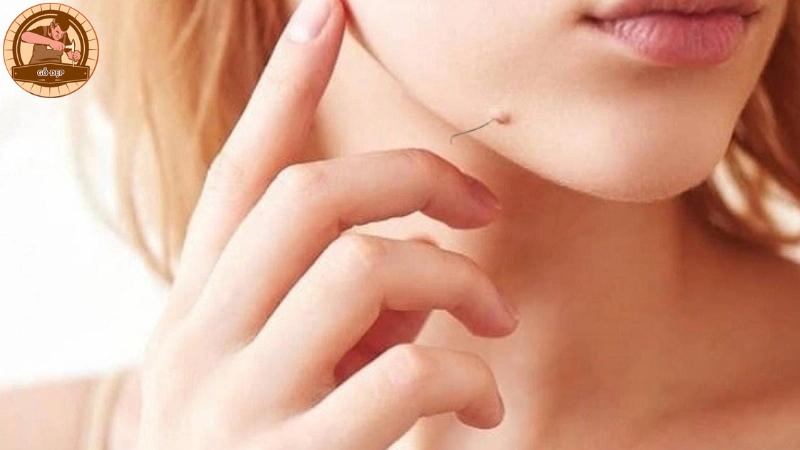Nốt ruồi ở cằm mọc lông