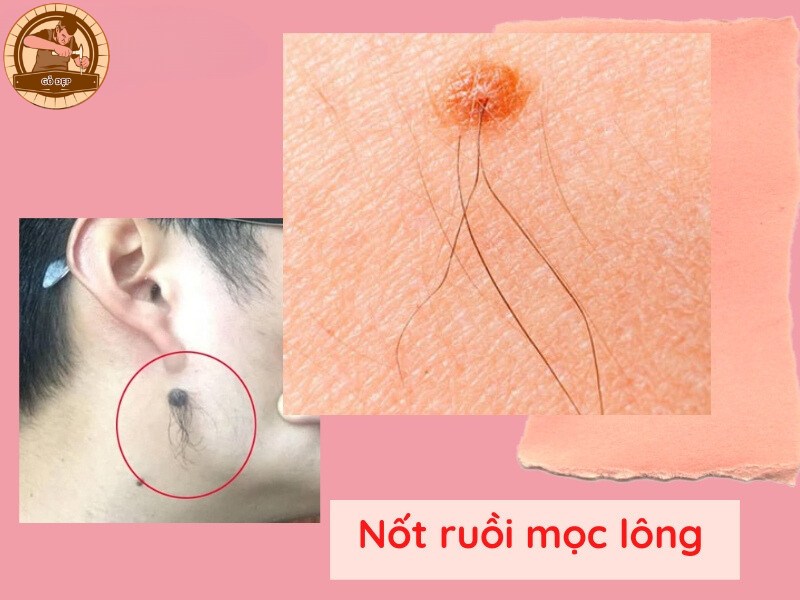 Ý nghĩa nốt ruồi ở cằm mọc lông