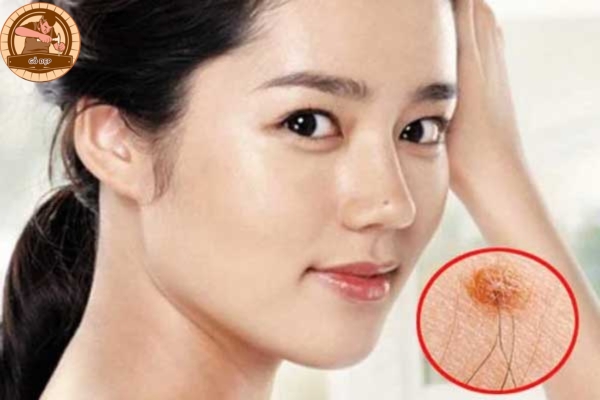 Cách xử lý khi gặp nốt ruồi ở cằm mọc lông