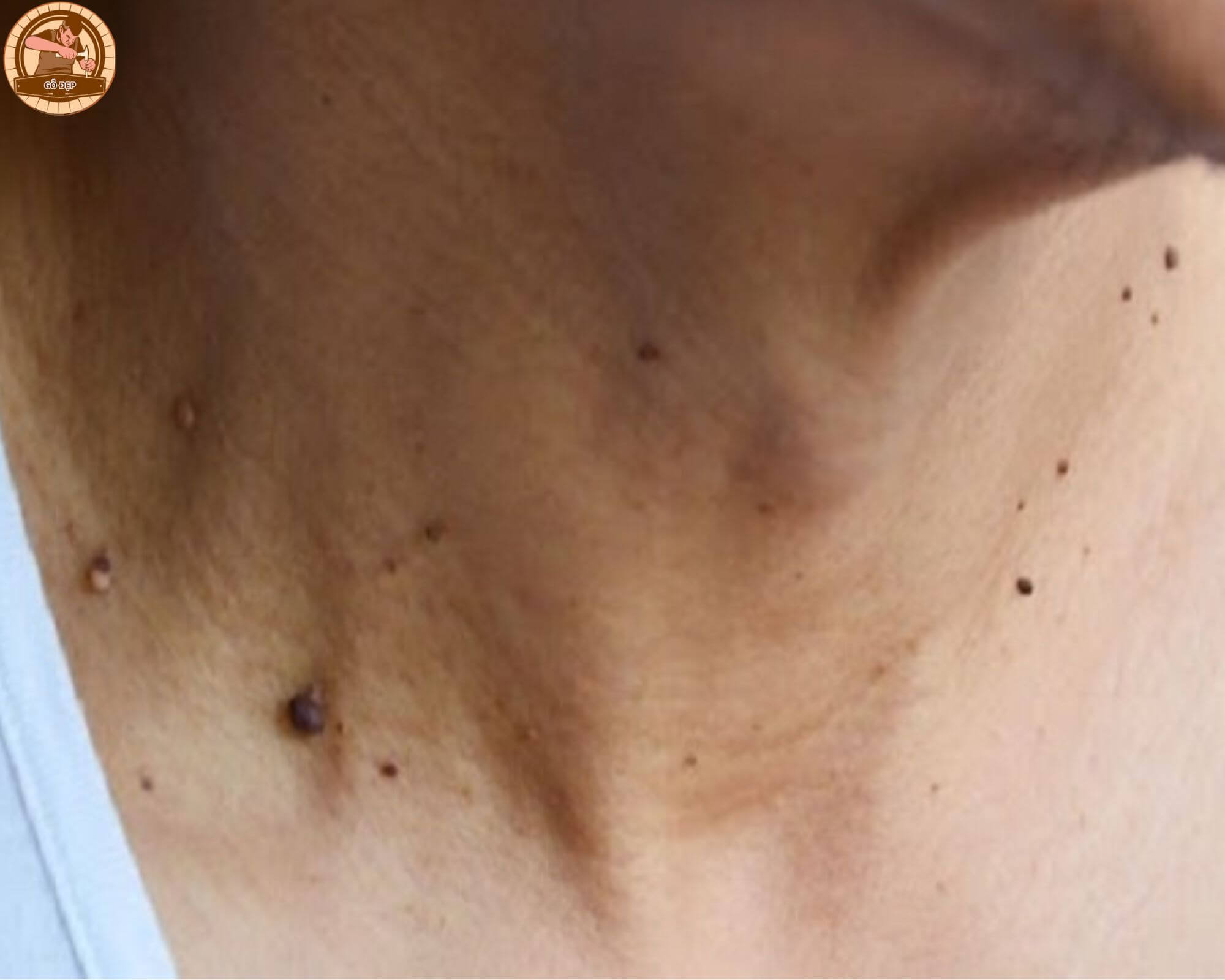 Ý nghĩa của nốt ruồi xanh ở nam giới