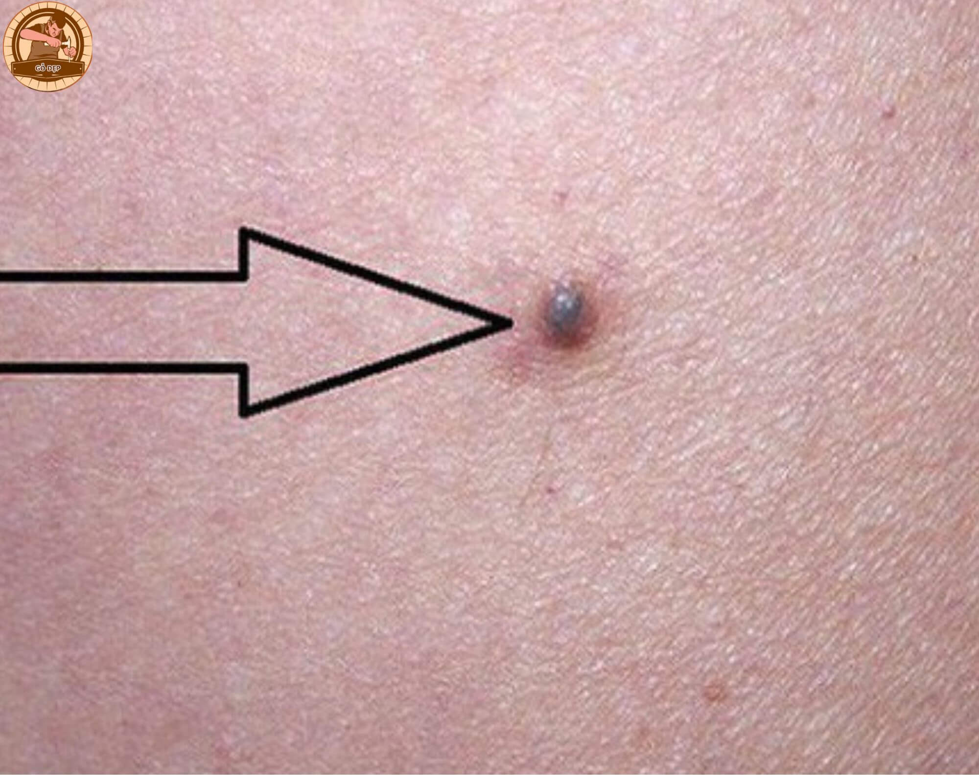 Nốt ruồi xanh có khác so với các nốt ruồi khác không?