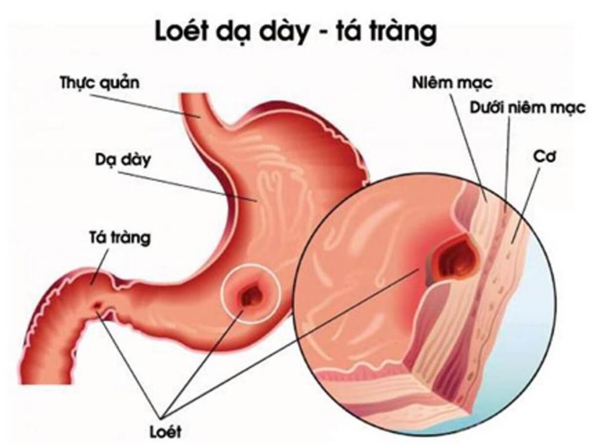 Loát-Dạ-Dày-Tá-Tràng