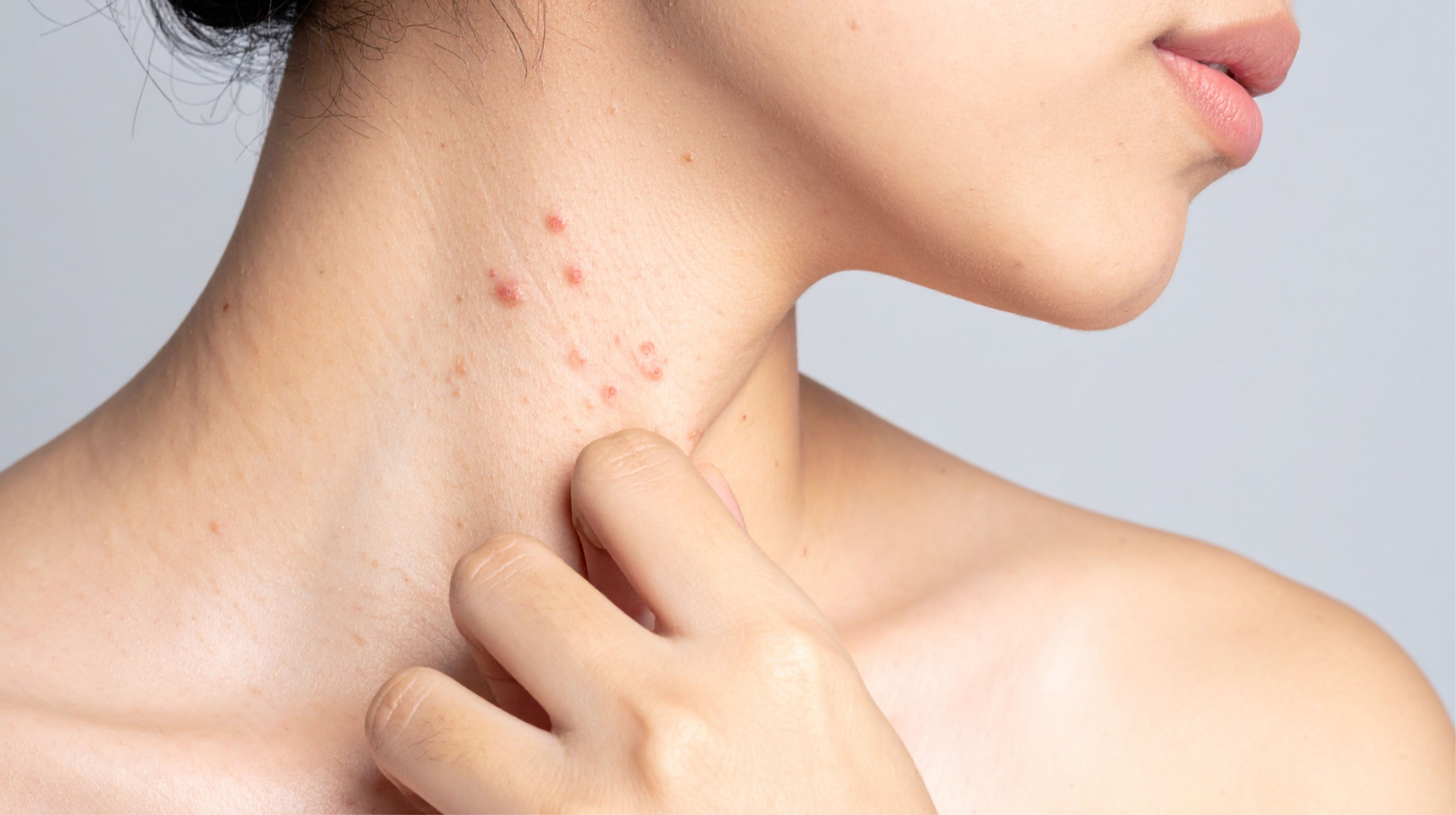 Cơ thể nổi mẩn đỏ, ngứa ngáy