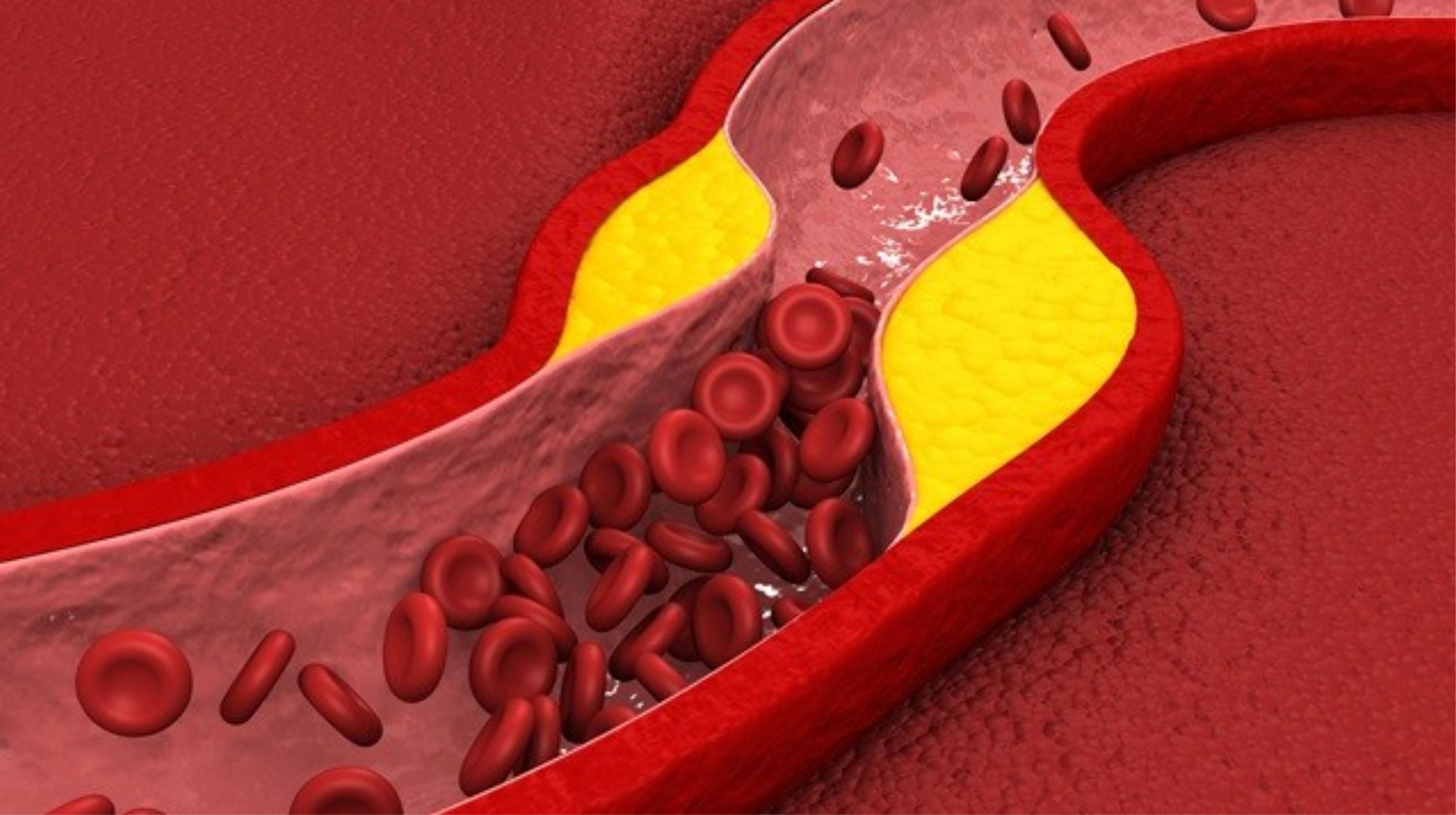 Tìm hiểu về nguyên nhân và triệu chứng máu nhiễm mỡ