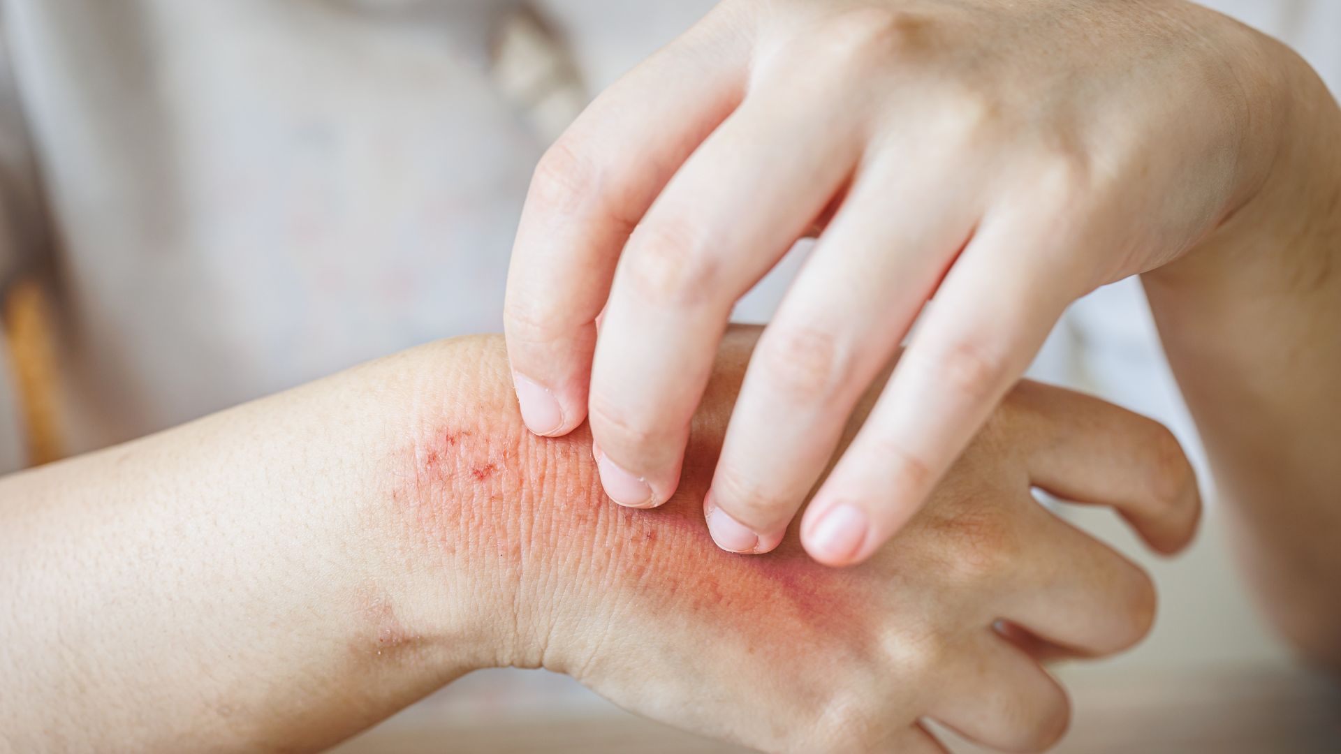 Người bị dị ứng với hải sản cần thận trọng khi uống Omega 3 nhuyễn thể