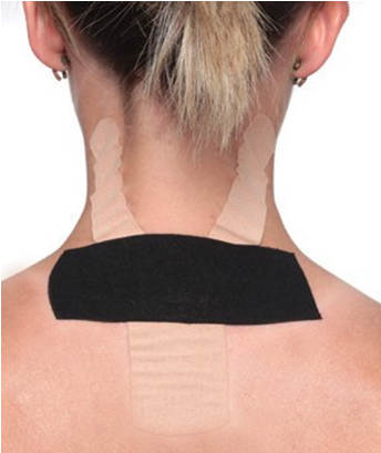 Ứng dụng PP Kinesio Taping điều trị đau cổ