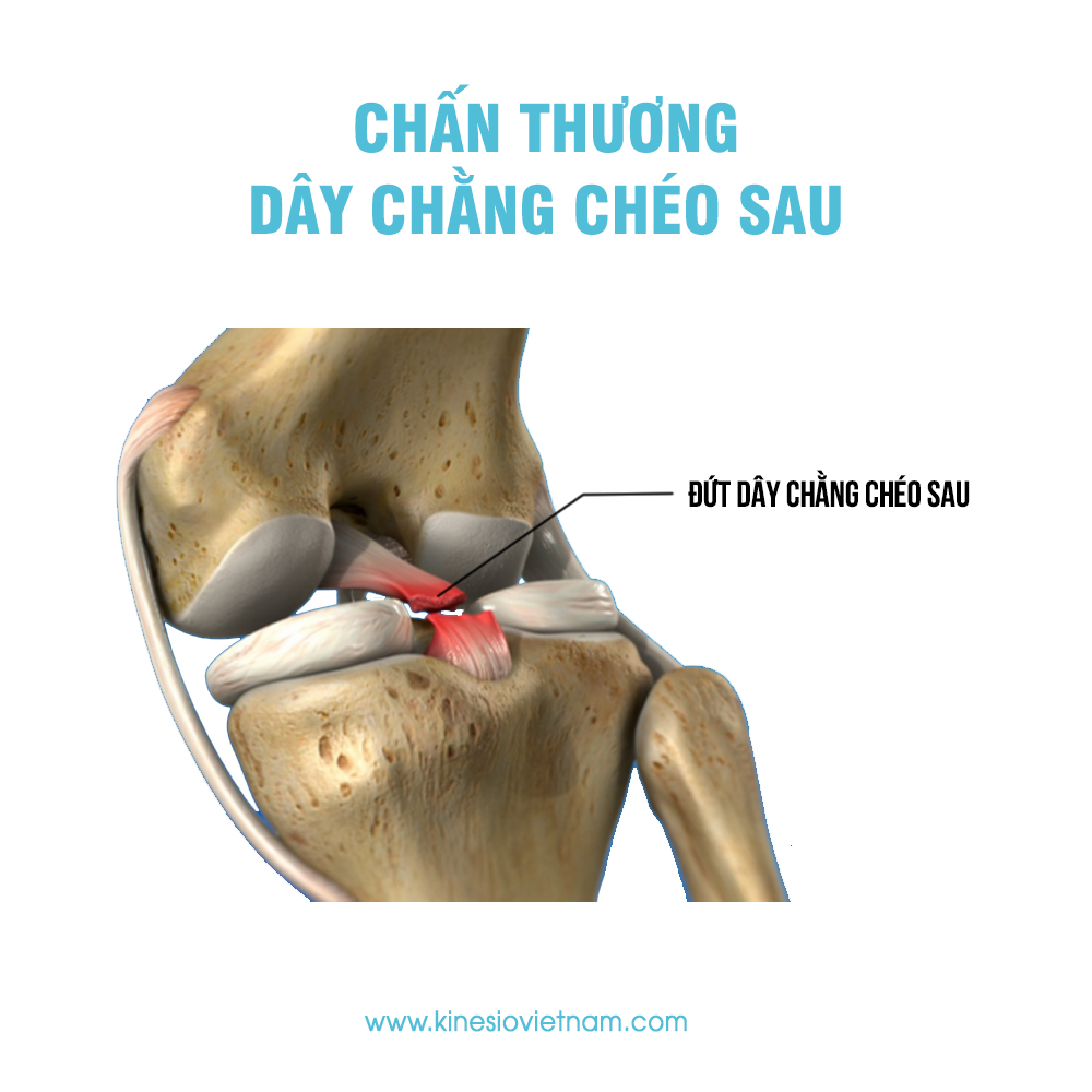 Chấn thương dây chằng chéo sau