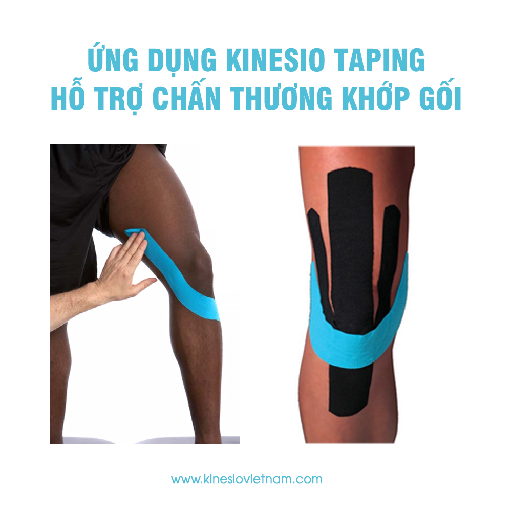 Ứng dụng Kinesio Taping hỗ trợ khớp gối