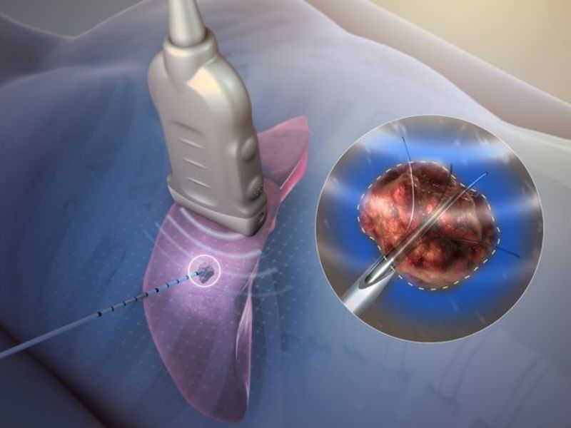 truong hop su dung song ngan tri lieu