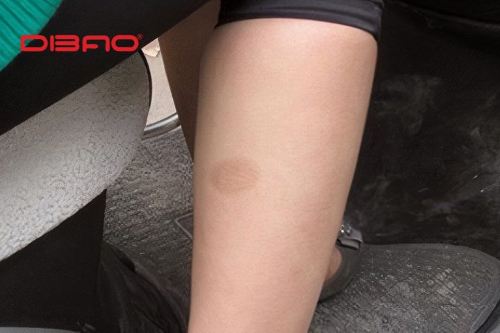 Một số lưu ý để trị bỏng bô xe máy tránh để lại sẹo