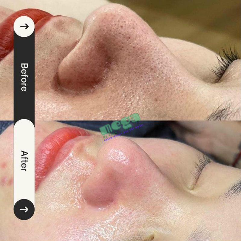 Histolab Aqua Peeling Solution BHA 520ml