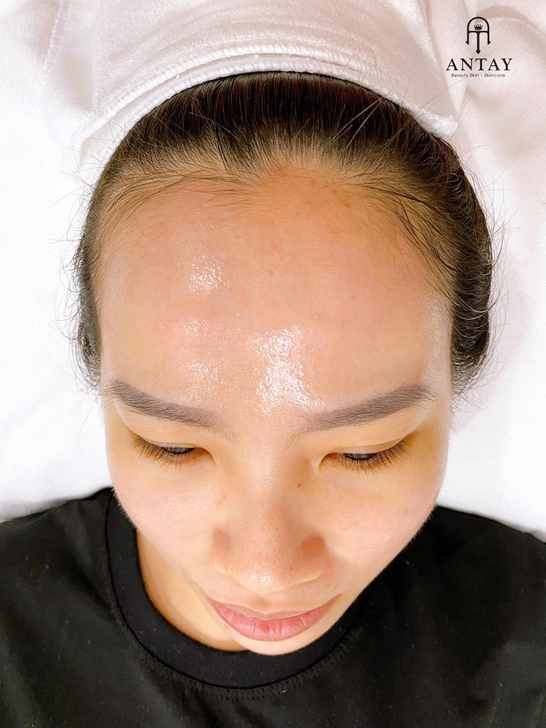 Liệu Trình Chemical Peel