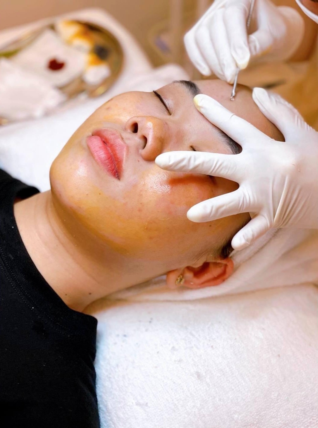 Liệu Trình Điều Trị Mụn Chuyên Sâu