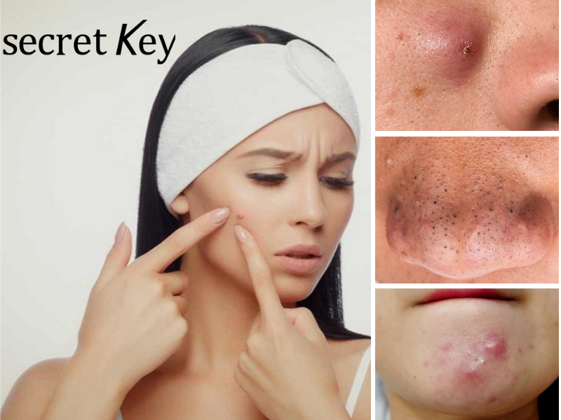 Mụn là một bệnh lý về da liễu là tình trạng các khối u xuất hiện ở các vị trí như mặt, lưng, bả vai,...