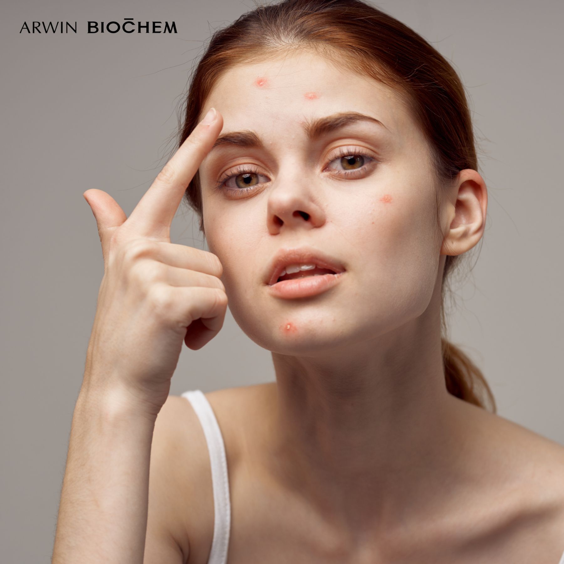 Vitamin C hỗ trợ ngừa mụn hiệu quả