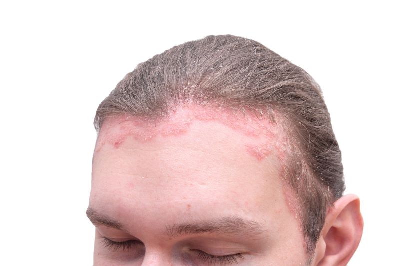 Những tác hại vô cùng nguy hiểm của thuốc nhuộm tóc