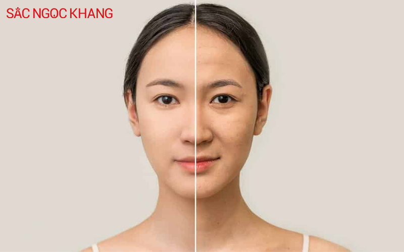 Làn da chịu tác động bởi môi trường gây sạm, nám