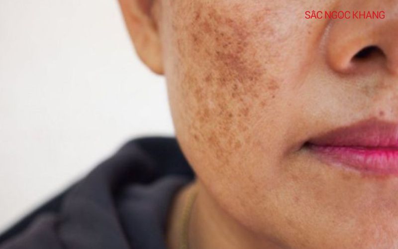 Nám càng nặng, khó điều trị nếu không được xử lý đúng cách