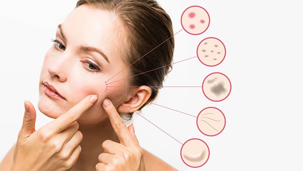 Acid azelaic là giải pháp loại bỏ khuyết điểm làn da