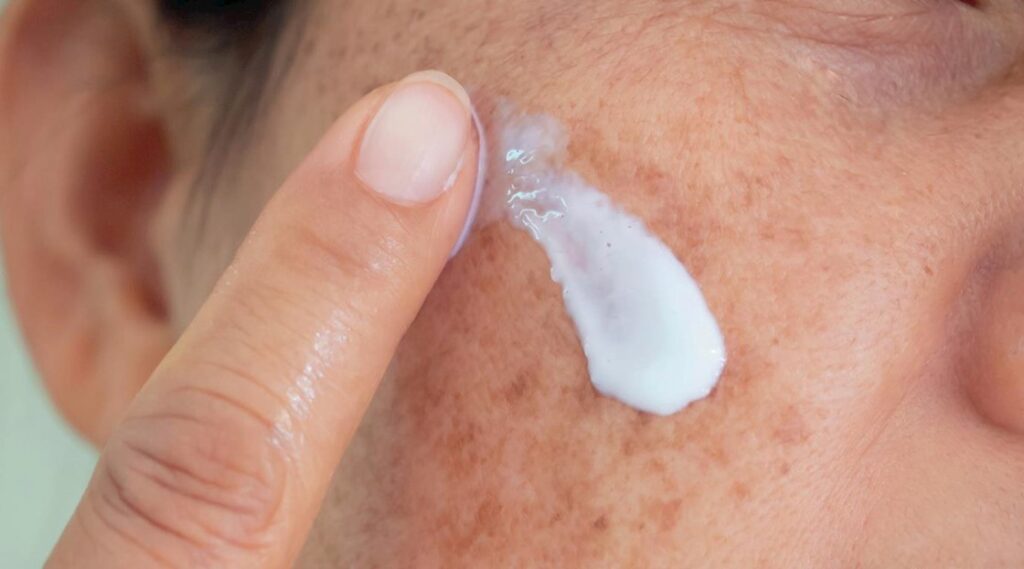 Tác dụng phụ của Acid Azelaic