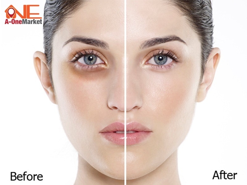 điều trị thâm quầng mắt