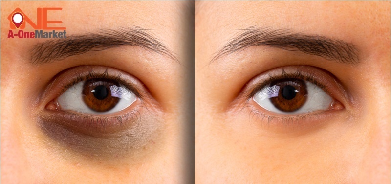 nguyên nhân thâm quầng mắt