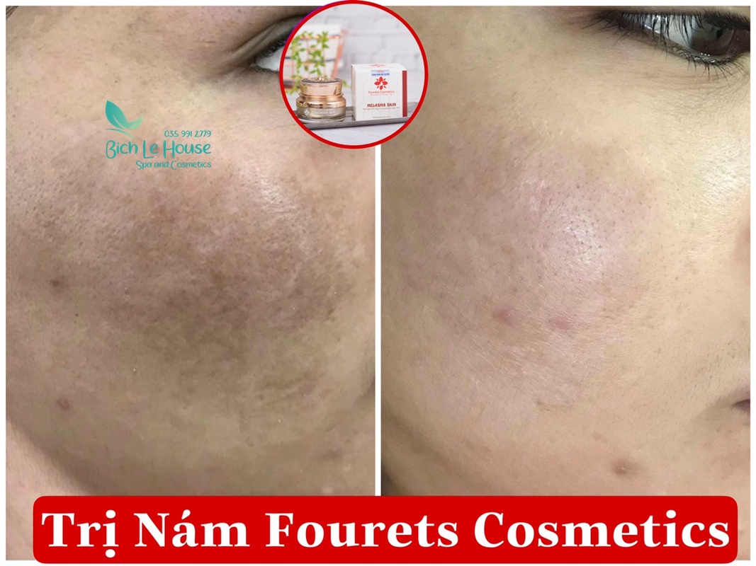 Kem đặc trị nám Melasma Skin