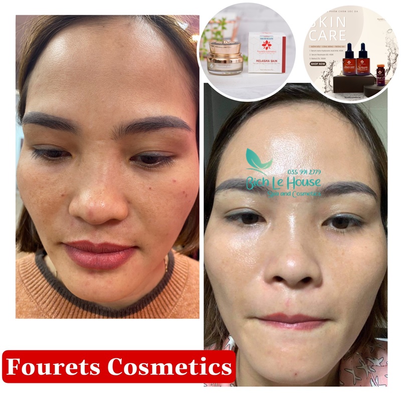 hiệu quả sử dụng sản phẩm Melasma skin Fourets Cosmetics