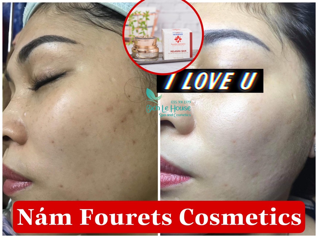 Hiệu quả sử dụng sản phẩm kem tan nám Melasma Skin Fourets Cosmetics