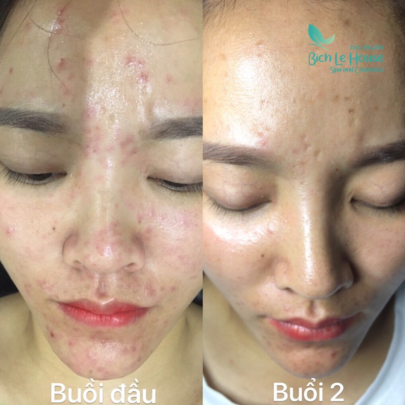 hiệu quả sử dụng sản phẩm SOS skin tại Spa Bích Lê House