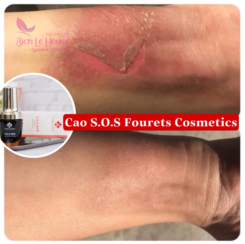 Kết quả sau khi sử dụng cao cấp cứu S.O.S Skin Fourets Cosmetics