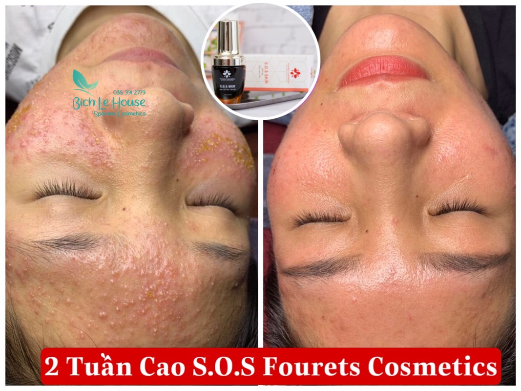 Cao cấp cứ SOS skin