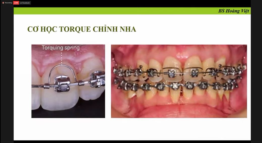 Cơ học torque trong chỉnh nha - Webinar SYD 2020